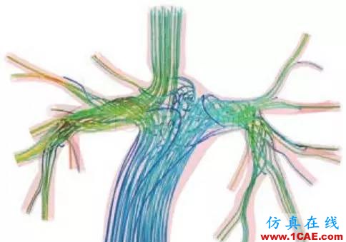 看ANSYS公司如何利用CFD助力心臟病患者手術fluent分析圖片4